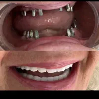 ایمپلنت با روکش زیرکونیا، کامپوزیت،اوردنچر