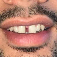 کامپوزیت ونیر