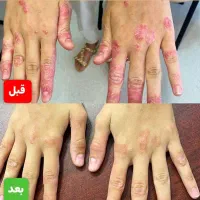 درمان بیماریهای پیسی وپسوریازیس واگزما  دائمی|خدمات آرایشگری و زیبایی|گرگان, |دیوار