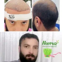 کاشت مو تخفیف ویژه هفته فقط  ۱۵تا۲۵