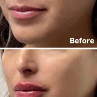 تزریق فیلر،بوتاکس ،لیزر موهای زائد ،فیشیال|خدمات آرایشگری و زیبایی|خرم‌آباد, |دیوار