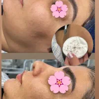 فشیال تخصصی واصلاح تخصصی درماپلینگ