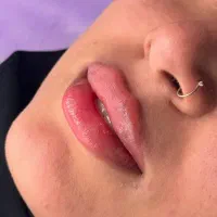 تزریق فیلر و بوتاکس با تخفیف ویژه در کلینیک زیبایی