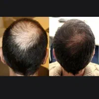 کیلینیک کویش ریشو مو