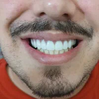 پروتز دندان (دندان مصنوعی)