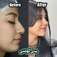 عمل بینی/جراحی بینی|خدمات آرایشگری و زیبایی|جهرم, |دیوار