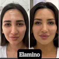 تزریق ژل بوتاکس فیلر در کلینیک زیبایی تهران|خدمات آرایشگری و زیبایی|تهران, یافت آباد جنوبی|دیوار