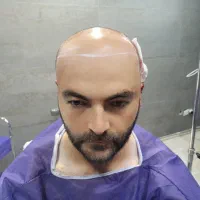مزوتراپی/درمان ریزش موقطعی|خدمات زیبایی و سلامت|تبریز, |دیوار