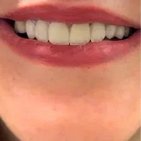 ایملنت ، لمینیت ، کامپوزیت در مطب شخصی|خدمات آرایشگری و زیبایی|تهران, نیاوران|دیوار