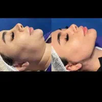 ساکشن شکم وپهلوفقط فقط۱۶درکلینیک انجام میشه