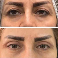 جراحی پلک بالاوپایین توسط متخصص .باتجربه بالا