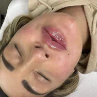 ژل،بوتاکس،مزو