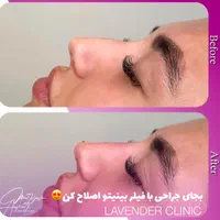آموزش تزریق فیلر،بوتاکس و لیزر توسط پزشک|خدمات آموزشی|آمل, |دیوار