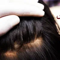 پاکسازی شپش در ده دقیقه بدون بازگشت