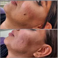 حذف خال و زگیل و رفع جای جوش و حفرات با تخفیف