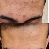 بهبودکبدچرب وغلظت خون با طب ابوعلی سینا