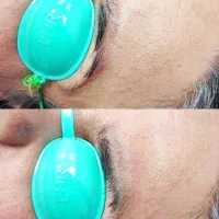 ریموو تتو و رفع تیرگی بدن در مطب پزشک|خدمات آرایشگری و زیبایی|آبادان, |دیوار