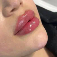 فیلر بادی،نخ لیفت،مزوتراپی،بوتاکس،فول فیس