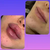 تزریق ژل و بوتاکس با مواد اصل و اورجینال|خدمات آرایشگری و زیبایی|ساری, |دیوار