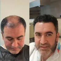 کاشت مو و ابرو وجراحی پلک باضمانتنانه وتمام اقساط|خدمات زیبایی و سلامت|تهران, نارمک|دیوار