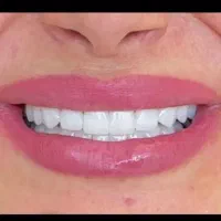 دندان مصنوعی برای افرادجوان تخفیف ویژه تاعید قربان
