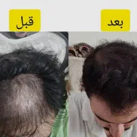 معجزه قرن/رشد ۳ برابری مو