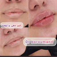 فیلر/ ژل لب تخصصی ۱.۳۰۰ ، بوتاکس پیشانی / لیفت۷۶۰|خدمات آرایشگری و زیبایی|مشهد, هدایت|دیوار