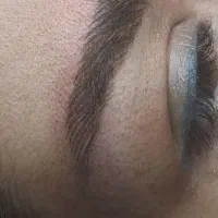 مدل فیبروز و میکروبلیدینگ به تعداد محدود