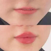 تزریق ژل .بوتاکس .انزیم بینی .مزوژل جوانساز|خدمات آرایشگری و زیبایی|جهرم, |دیوار