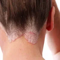 بهبود کامل و ریشه ای پسوریازیس