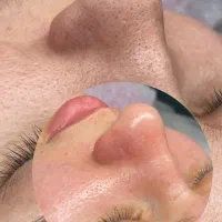 مدل فشیال صورت ، مزونیدلینگ