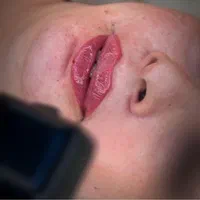 لیزرموهای زائد فیلر لب مزوتراپی بلفاروپلاستی