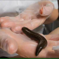 بادکش، حجامت ، زالو درمانی