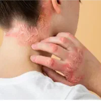 درمان اگزما و بواسیر ، ترک پا دیابتی