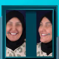 پایینترین قیمت،بهترین کیفیت،جشنواره پاییزه ایمپلنت|خدمات زیبایی و سلامت|شیراز, ملاصدرا|دیوار