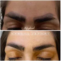 پاک‌کردن تتو صورت در یک جلسه