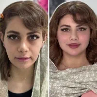 تزریق تخصصی ژل وبوتاکس،چربی،هایفو،نخ،توسط پزشک|خدمات آرایشگری و زیبایی|کرمانشاه, |دیوار
