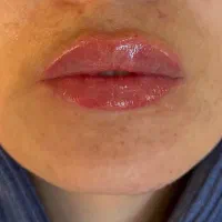 تزریقات فیلر و بوتاکس توسط پزشک|خدمات آرایشگری و زیبایی|تهران, جوادیه|دیوار