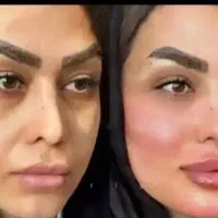 فیلر،بوتاکس چربی مزوتراپی مووپوست پی آرپی پرسینگ