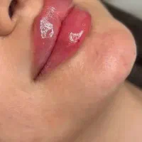 تزریق ژل لب/بوتاکس /فیلر بادی/لیفت نخ وکانتورینگ