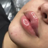 تزریق ژل و بوتاکس سارینا بیوتی