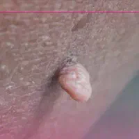 راهنمایی داوطلبانه درباره زگیل تناسلی