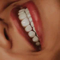 ایمپلنت لمینت کامپوزیت ارتودنسی روکش