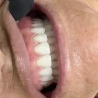 پروتز متحرک طرح لمینیت