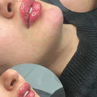 ژل بوتاکس سی سی ۵۰۰|خدمات آرایشگری و زیبایی|قرچک, میرزائی جنوبی|دیوار