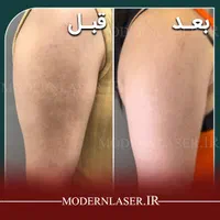 درمان کامل انواع لک پوستی توسط پزشک|خدمات آرایشگری و زیبایی|اصفهان, سعادت‌آباد|دیوار