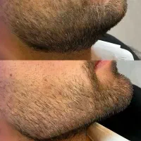 جشنواره تخفیفی تزریقات،کربن، ژل و بوتاکس،لیزر