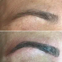 ریموو تتو ابرو/  لیزر کیوسوییچ  تضمینی /کربن تراپی
