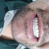 دندانسازی (دندان مصنوعی)پروتز متحرک|خدمات آرایشگری و زیبایی|قم, شاه ابراهیم|دیوار