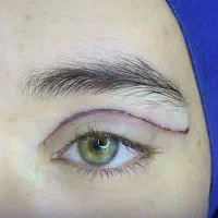 بلفارو  پلاستی بخیه لیزری ساکشن